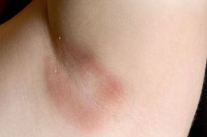 Hyperpigmentation is often triggered by skin irritation.