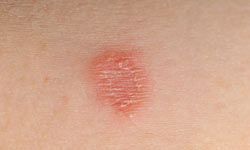 ringworm