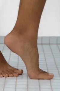 Tinea, the fungal infection responsible for athlete's foot, can affect almost any area of your skin.