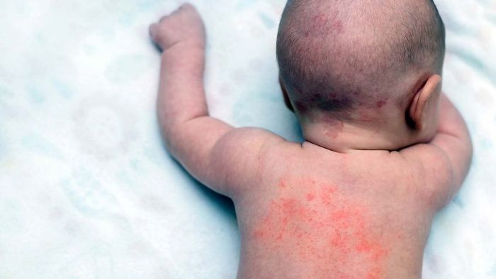 heat rash