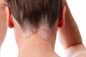 psoriatic condition