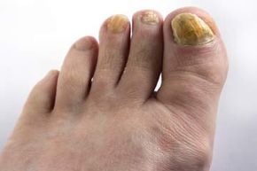 Toenail fungal infections. Delightful.