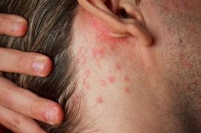 individual experiencing a skin rash