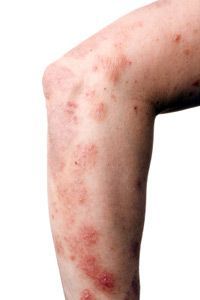 A skin condition that causes itching, commonly seen on the elbow and throughout the arm.
