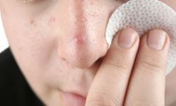 salicylic acid pad
