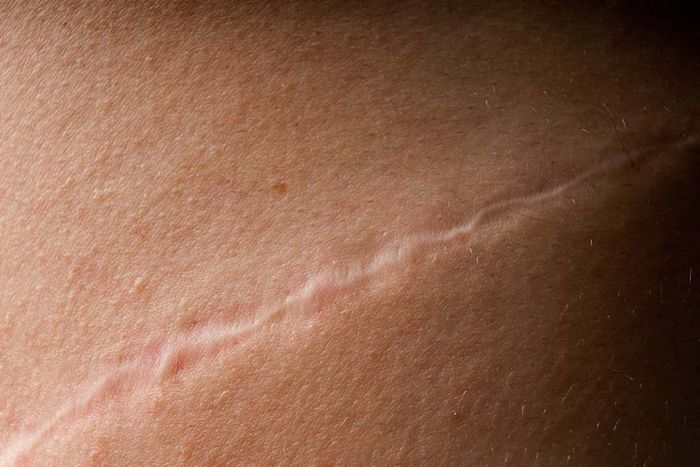 A close-up view of a scar on someone's skin