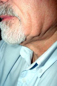 A detailed view of an older man's jawline and neck, highlighting the impact of aging and loss of skin elasticity.