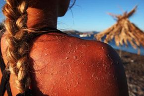 Peeling Skin from Severe Sunburn