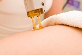 Device for laser hair removal.