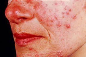 Rosacea is a persistent skin inflammation characterized by facial redness and the appearance of tiny, red, pus-filled bumps or pustules.