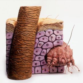 Visualization of the Itch Mite (Sarcoptes scabiei) tunneling beneath human skin