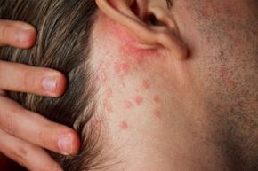 Psoriasis affecting the neck area