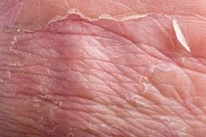 A man's hand showing signs of skin peeling