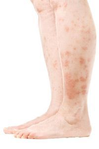A persistent itchy skin condition affecting the entire leg area.