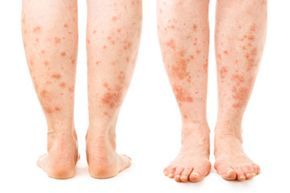 A skin condition causing itching across the legs, visible from both front and back angles.
