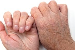 Dryness affecting the hands.
