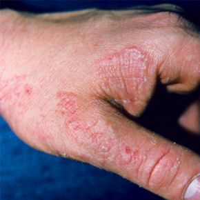 Fungal infection on the hand, known as Tinea manus.