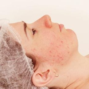 A woman undergoing treatment for acne scars.