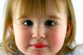A toddler suffering from a fever blister.