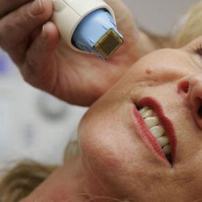 Dr. Michael Krueger employs the innovative 'ThermaTip' tool during patient procedures.