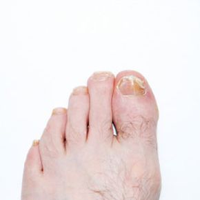 Nail infections.