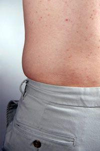 A man's back covered with acne.
