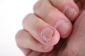 The Habit of Nail Biting