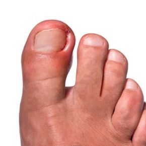 A man's foot affected by an ingrown toenail.