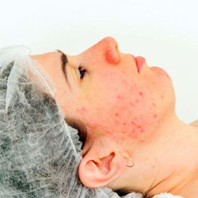 A young woman dealing with acne scars