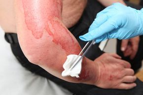 First-degree burn.