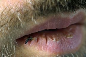 chapped lips