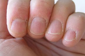Fingernails in poor health.