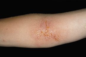 A rash on a person's arm triggered by exposure to Poison Ivy (Toxicodendron (Rhus) radicans). This plant is a frequent cause of contact dermatitis and allergic reactions due to its toxicodendrol content.