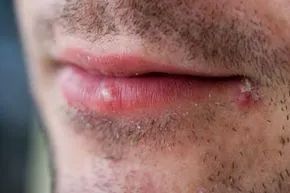A detailed view of a man displaying two cold sores on his lip.