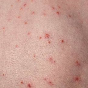 A case of folliculitis appearing on a child's back.