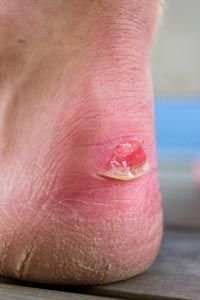 A blister on a man's heel accompanied by dry, cracked skin.