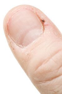 Painful hangnail on the thumb.