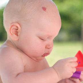An infant with hemangiomas, often referred to as strawberry birthmarks.