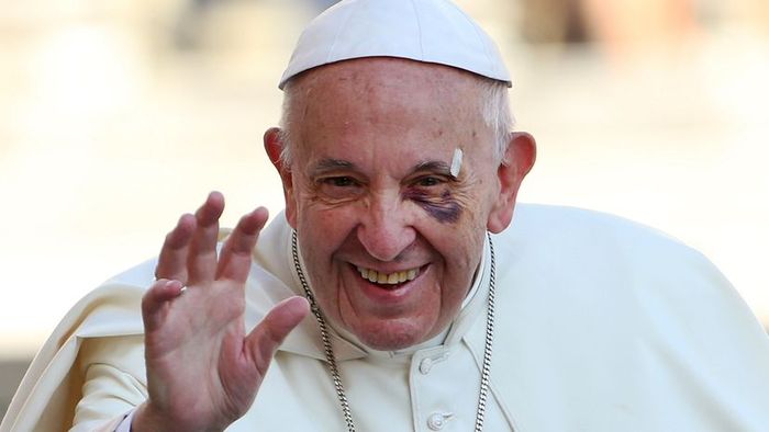 Pope with a bruised eye