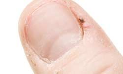 Painful hangnail on thumb.