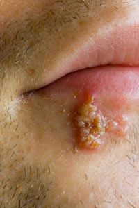 A prominent fever blister on a man's lower lip