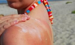 sunburned shoulder