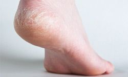 Cracked, dry heels