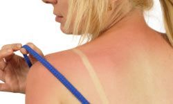 Girl with severe sunburn on her back and shoulders.
