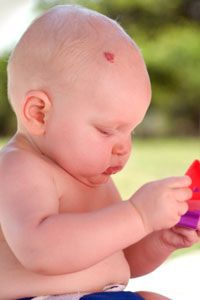 a baby with a birthmark