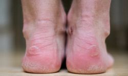 Heels with blisters