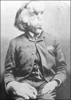 The final photograph of Joseph Merrick (around 1890).