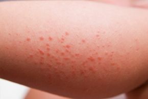A rash appearing on the leg of a one-year-old girl.