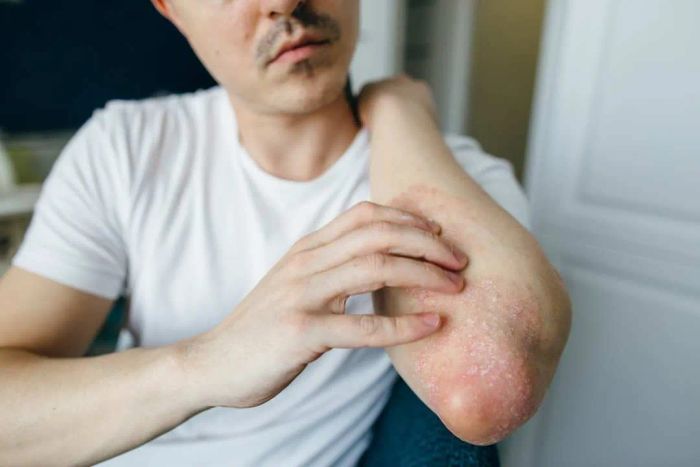 A close-up view of a man experiencing eczema on his elbow.