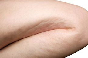 Close-up of cellulite on a woman's leg isolated on a white background